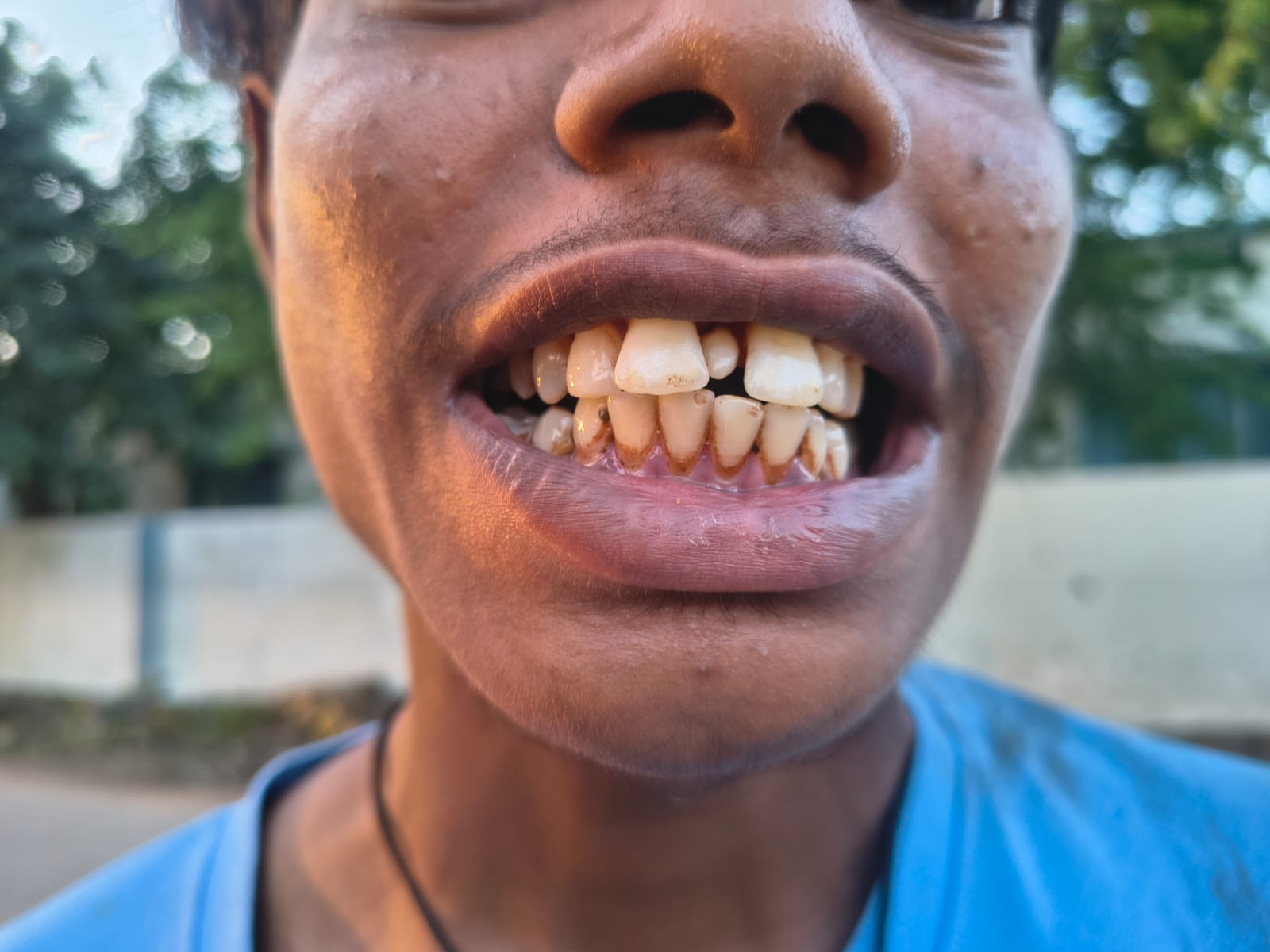 Dental treatment after — patient 7 smile transformation at Durge Dental Mancherial